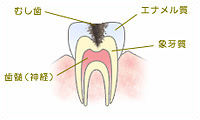 C2　象牙質（歯の内部）の虫歯